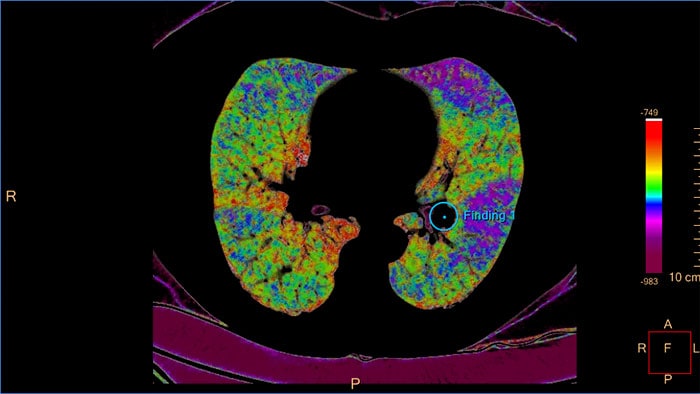 pulmonary artery analysis thumbnail