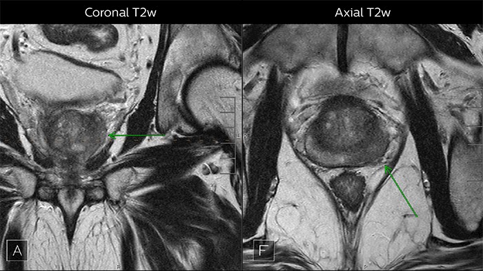 Images from multiparametric MRI of a classic peripheral zone lesion in the prostate