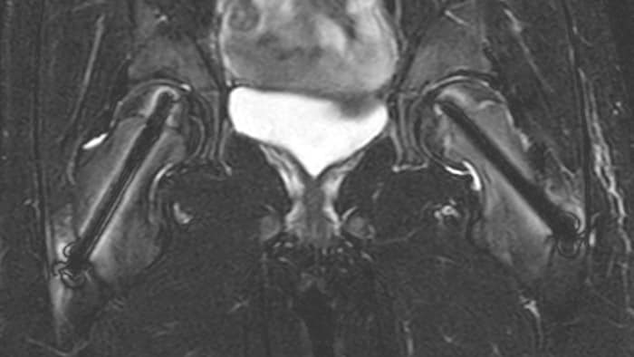 Slipped capital femoral epiphysis