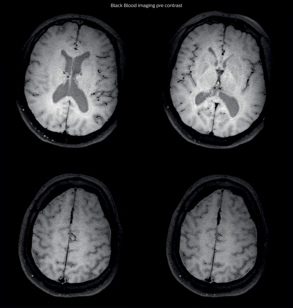 Black Blood Imaging Case Pre contrast