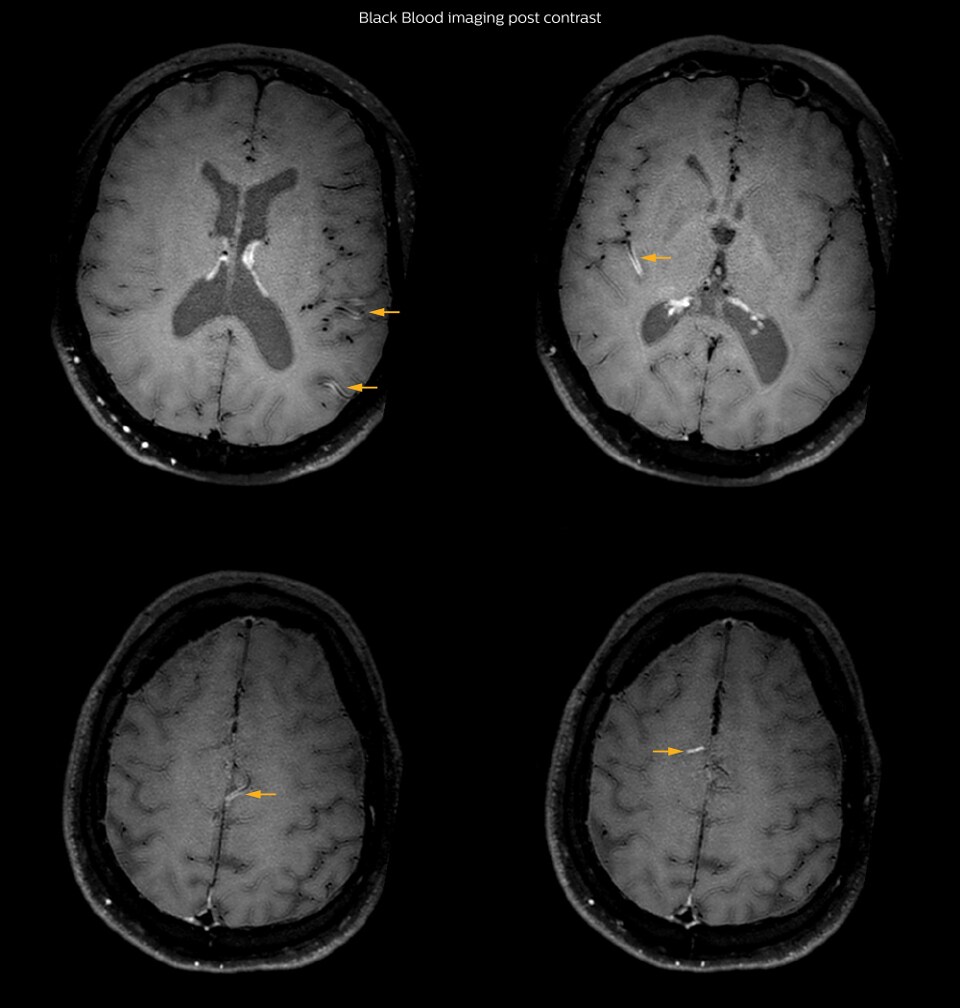 Black Blood Imaging Case Post contrast