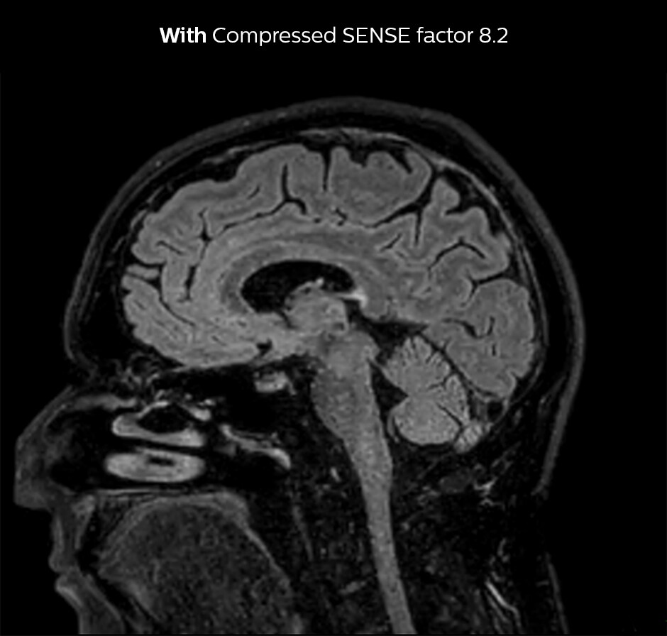 3D FLAIR brain Compressed SENSE factor8