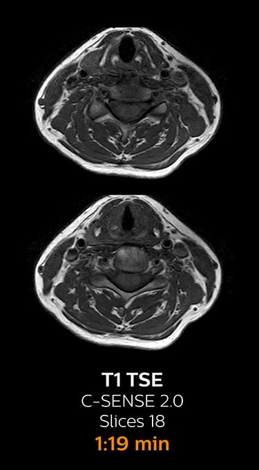 T1 TSE ax magnetic resonance