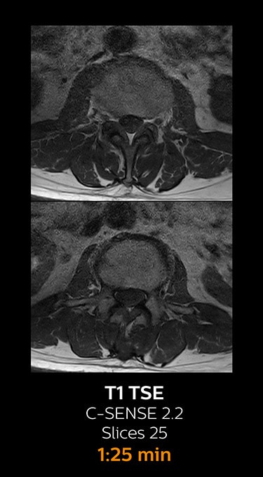 T1 TSE magnetic resonance