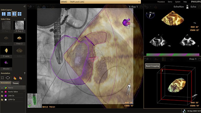 Echonavigator augmented visualization