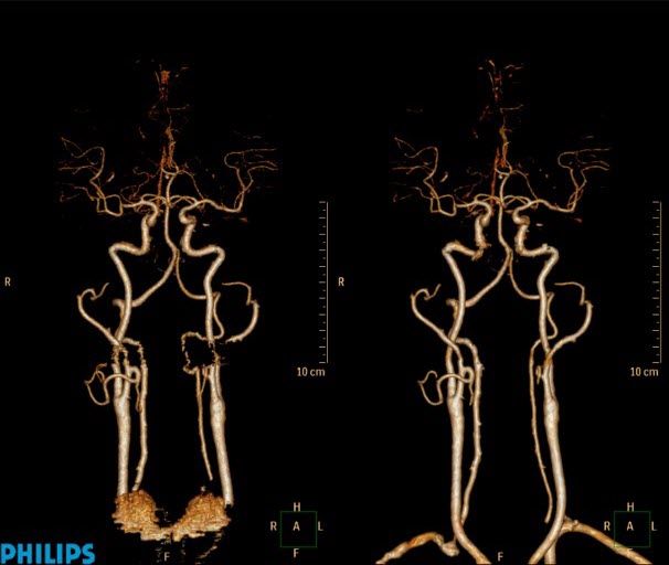 Head and Neck Angiogram