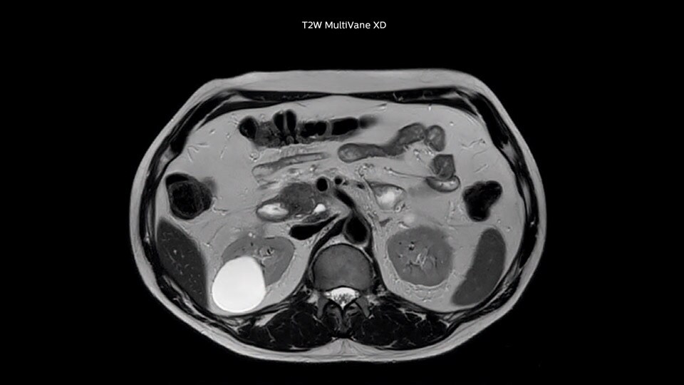 Bremen Clinical case Pancreas tumor