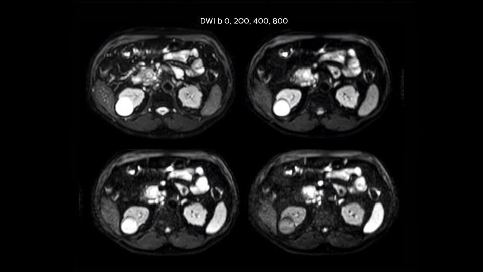 Bremen Clinical case Pancreas tumor